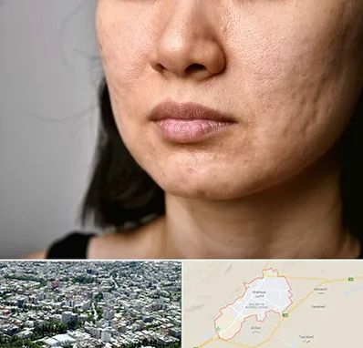 سابسیژن جای جوش در شاهرود