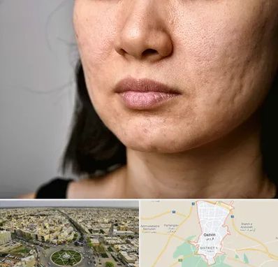 سابسیژن جای جوش در قزوین