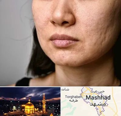 سابسیژن جای جوش در مشهد