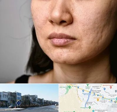 سابسیژن جای جوش در شریعتی مشهد