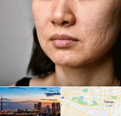 سابسیژن جای جوش در غرب تهران 