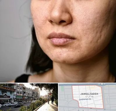 سابسیژن جای جوش در خیابان جمالزاده