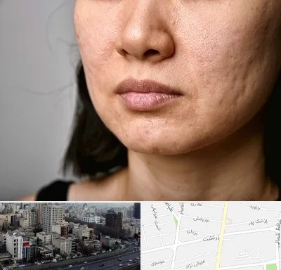 سابسیژن جای جوش در زرتشت