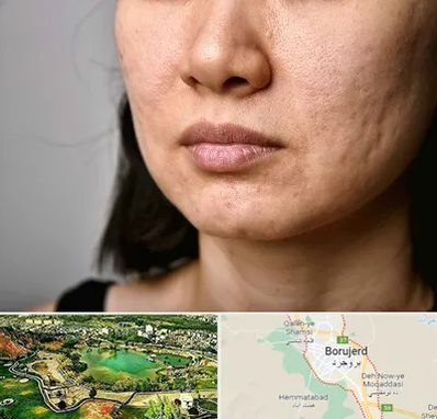 سابسیژن جای جوش در بروجرد