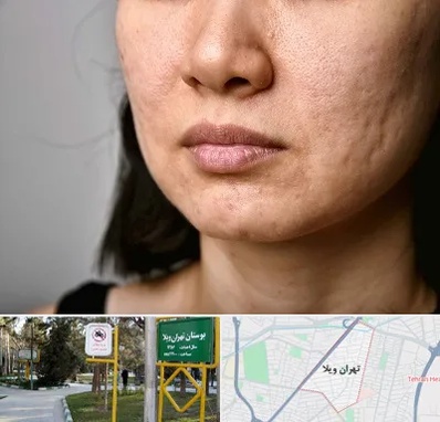 سابسیژن جای جوش در تهران ویلا