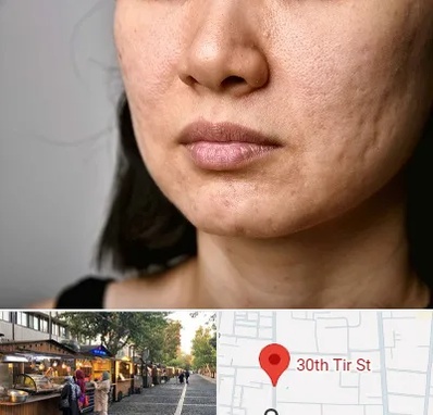 سابسیژن جای جوش در سی تیر