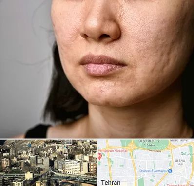 سابسیژن جای جوش در مرزداران 