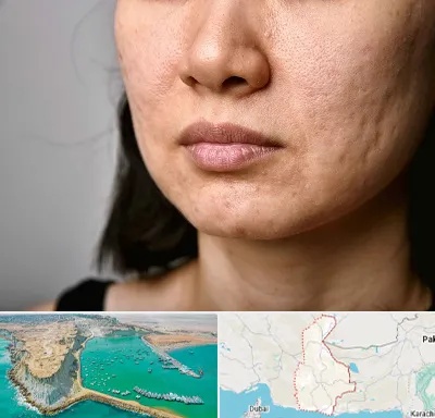 سابسیژن جای جوش در سیستان و بلوچستان