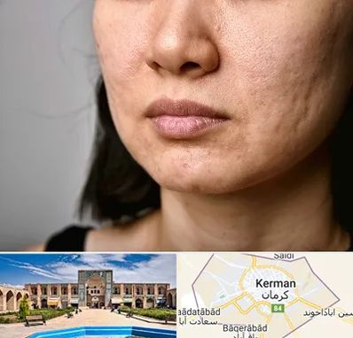 سابسیژن جای جوش در کرمان