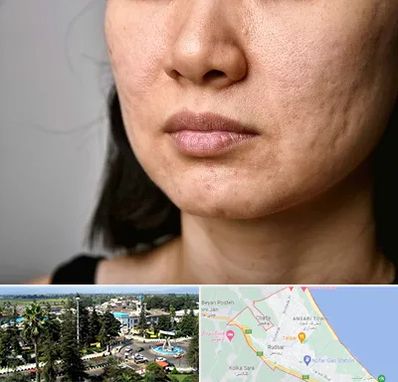 سابسیژن جای جوش در رودسر