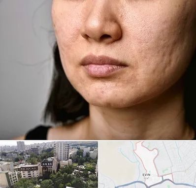 سابسیژن جای جوش در اوین