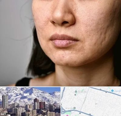 سابسیژن جای جوش در ازگل