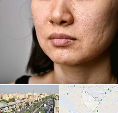 سابسیژن جای جوش در کیانمهر کرج