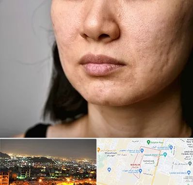 سابسیژن جای جوش در مارلیک کرج