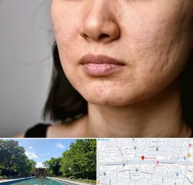 سابسیژن جای جوش در هشت بهشت اصفهان