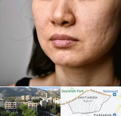 سابسیژن جای جوش در اختیاریه 