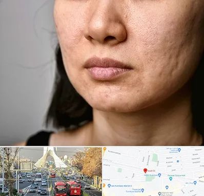 سابسیژن جای جوش در خیابان آزادی 