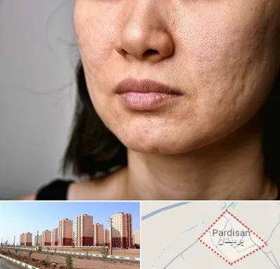 سابسیژن جای جوش در پردیسان قم