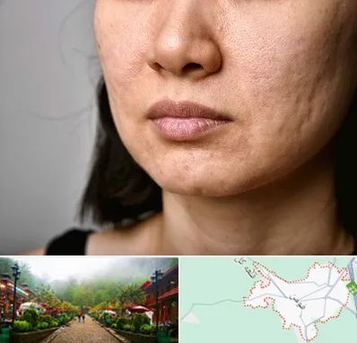 سابسیژن جای جوش در فومن