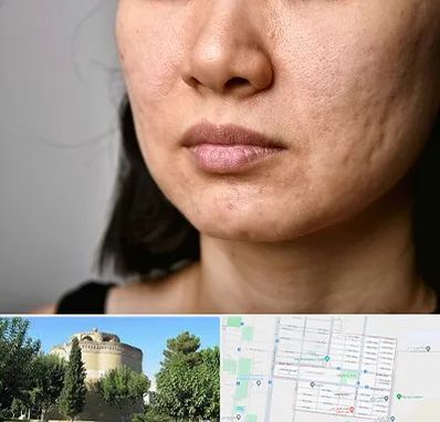 سابسیژن جای جوش در مرداویج اصفهان