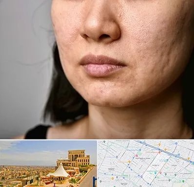 سابسیژن جای جوش در هاشمیه مشهد