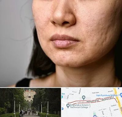 سابسیژن جای جوش در بلوار معلم رشت 