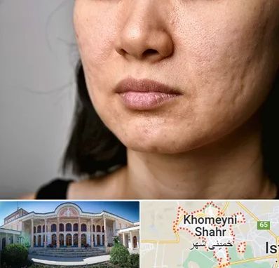 سابسیژن جای جوش در خمینی شهر