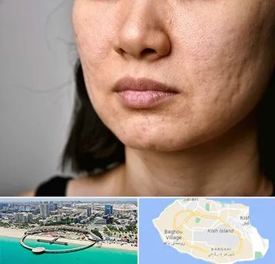 سابسیژن جای جوش در کیش