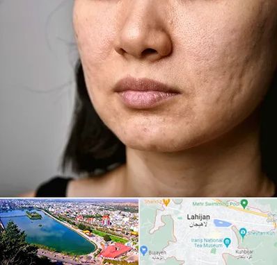 سابسیژن جای جوش در لاهیجان