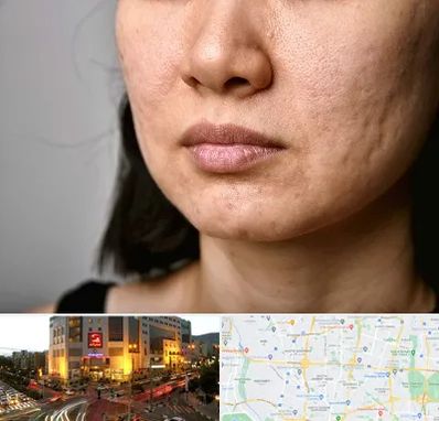 سابسیژن جای جوش در جنت آباد تهران 