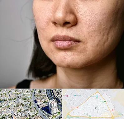 سابسیژن جای جوش در قاسم آباد مشهد 