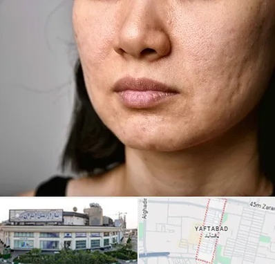 سابسیژن جای جوش در یافت آباد