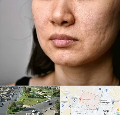 سابسیژن جای جوش در شاهین ویلا کرج