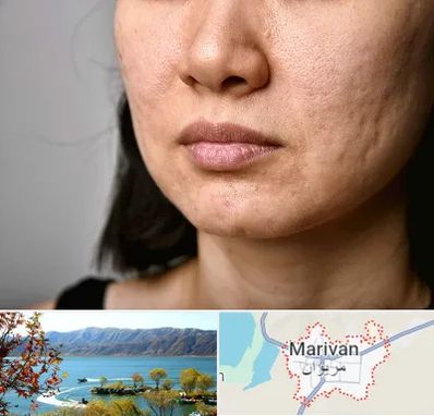 سابسیژن جای جوش در مریوان