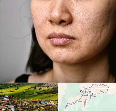 سابسیژن جای جوش در کلاردشت