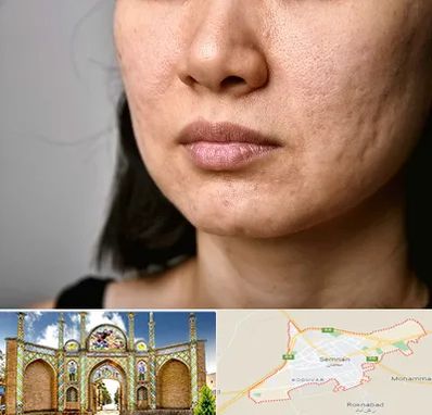 سابسیژن جای جوش در سمنان