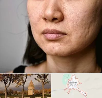 سابسیژن جای جوش در تویسرکان