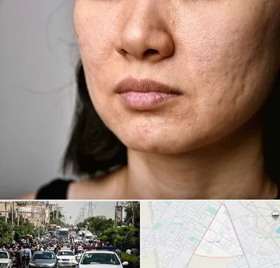 سابسیژن جای جوش در سیدی مشهد