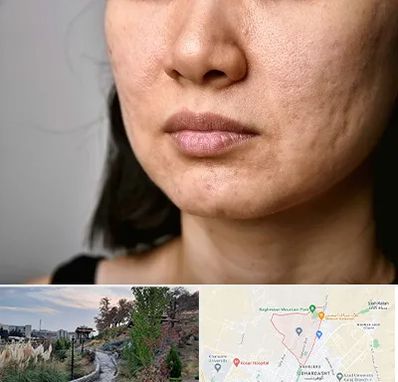 سابسیژن جای جوش در باغستان کرج