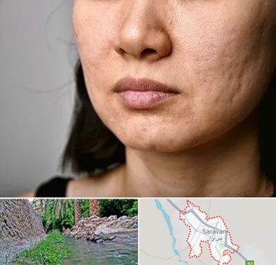 سابسیژن جای جوش در سراوان