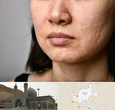 سابسیژن جای جوش در شهرضا