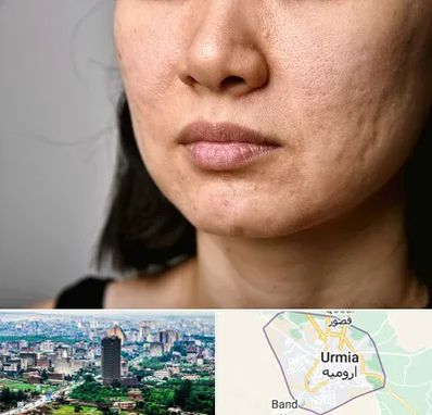 سابسیژن جای جوش در ارومیه