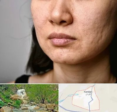 سابسیژن جای جوش در کردان