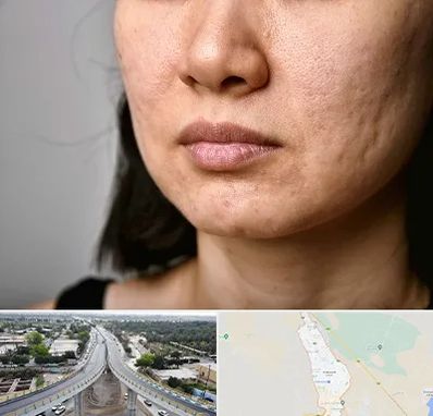 سابسیژن جای جوش در اندیمشک