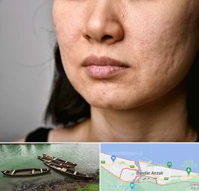 سابسیژن جای جوش در بندر انزلی