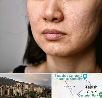 سابسیژن جای جوش در زعفرانیه 