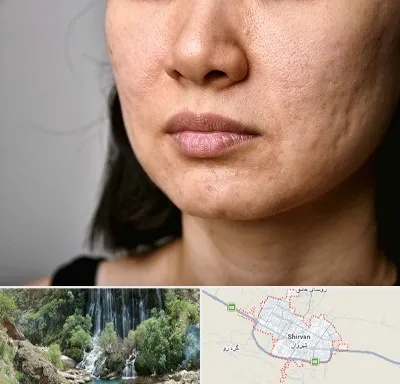 سابسیژن جای جوش در شیروان