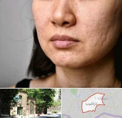 سابسیژن جای جوش در دزاشیب