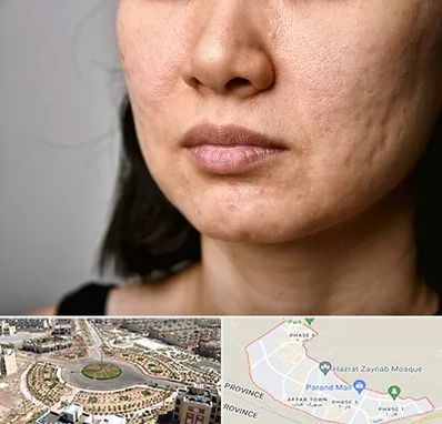 سابسیژن جای جوش در پرند