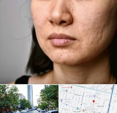 سابسیژن جای جوش در امامت مشهد